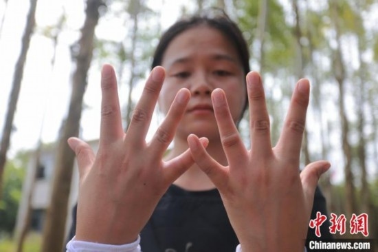 吳素英展示被蜜蜂蜇過的雙手。湯曉逵 攝